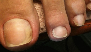Onychomycosis stop